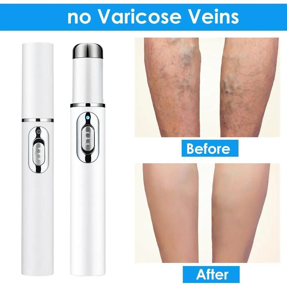 Varicose Veins Pen - Blue Light Therapy Pen Relieves Pain, Improves Circulation