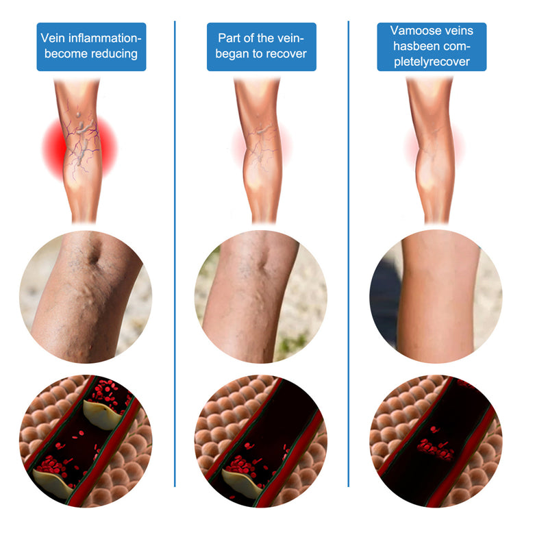 Varicose Veins Pen - Blue Light Therapy Pen Relieves Pain, Improves Circulation