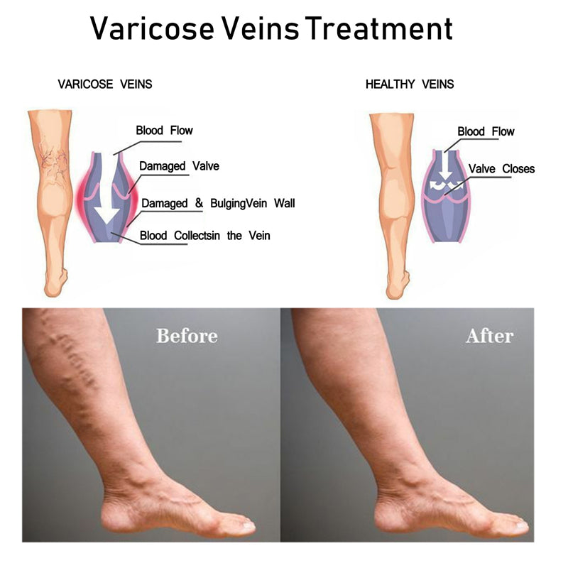 Varicose Veins Pen - Blue Light Therapy Pen Relieves Pain, Improves Circulation