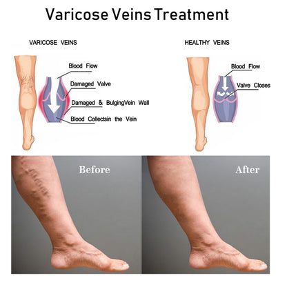 Varicose Veins Pen - Blue Light Therapy Pen Relieves Pain, Improves Circulation