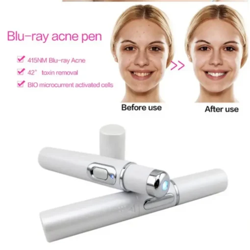 Spider Veins Removal Pen – Blue Light Treatment Laser Pen Soft Acne Scars Wrinkle Removal Visible Clear Light Therapy3