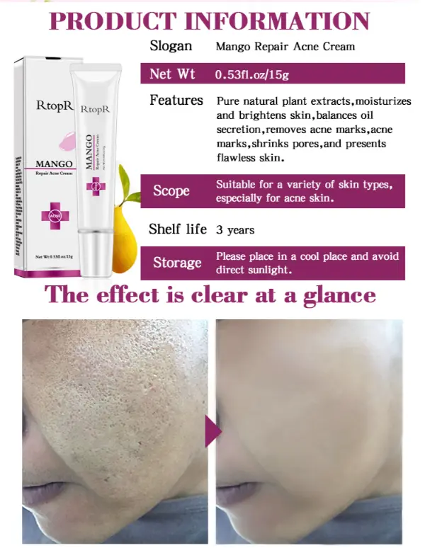 Acne Treatment Face Cream Blackhead Repair Gel Oil Control Shrink Pores Scar Whitening Moisturizer