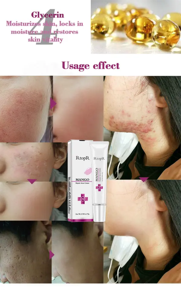 Acne Treatment Face Cream Blackhead Repair Gel Oil Control Shrink Pores Scar Whitening Moisturizer