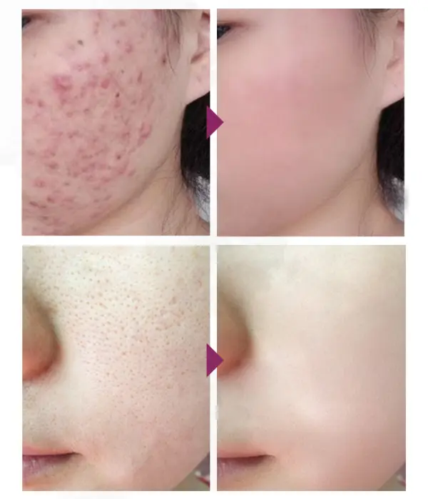 Acne Treatment Face Cream Blackhead Repair Gel Oil Control Shrink Pores Scar Whitening Moisturizer