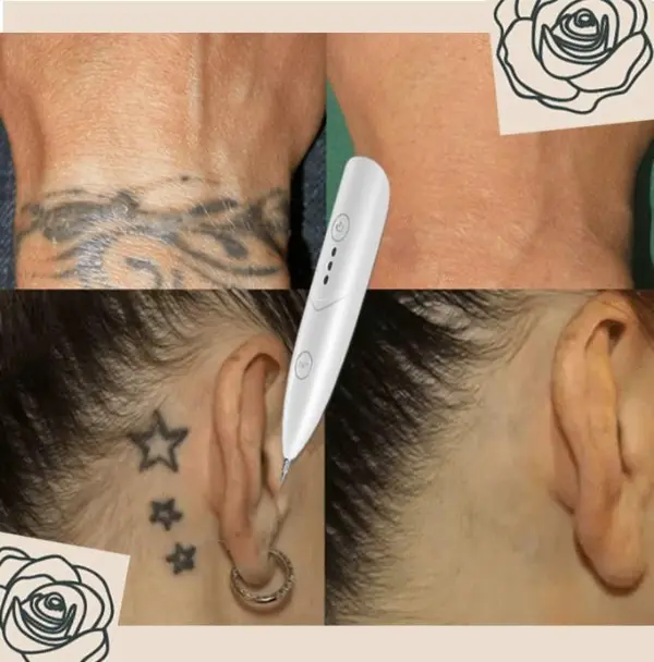 Instant-Tattoo-Removal-Pen