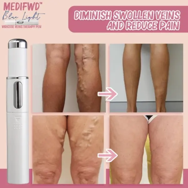 Medifwd-Blue-Light-Therapy-Varicose-Veins-Pen