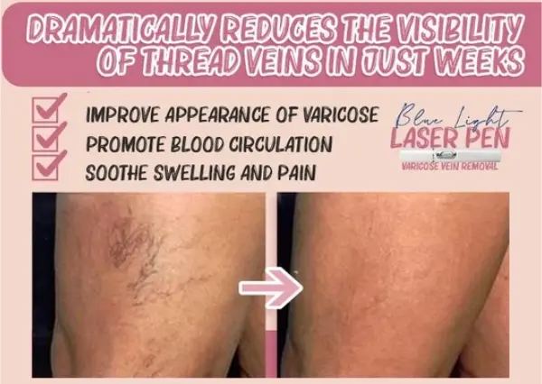 Spider Veins Removal Pen