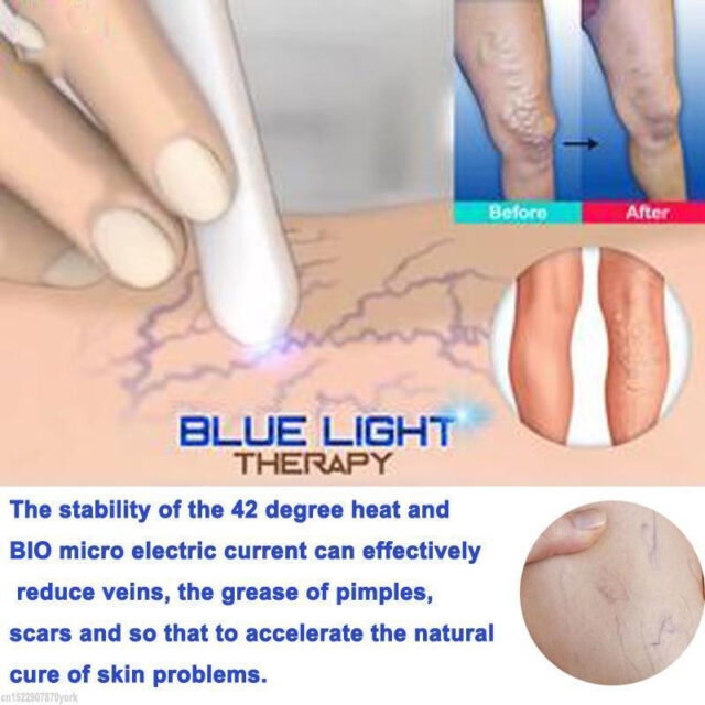 Varicose Veins Pen Relieves Pain & Improves Circulation - Image 2