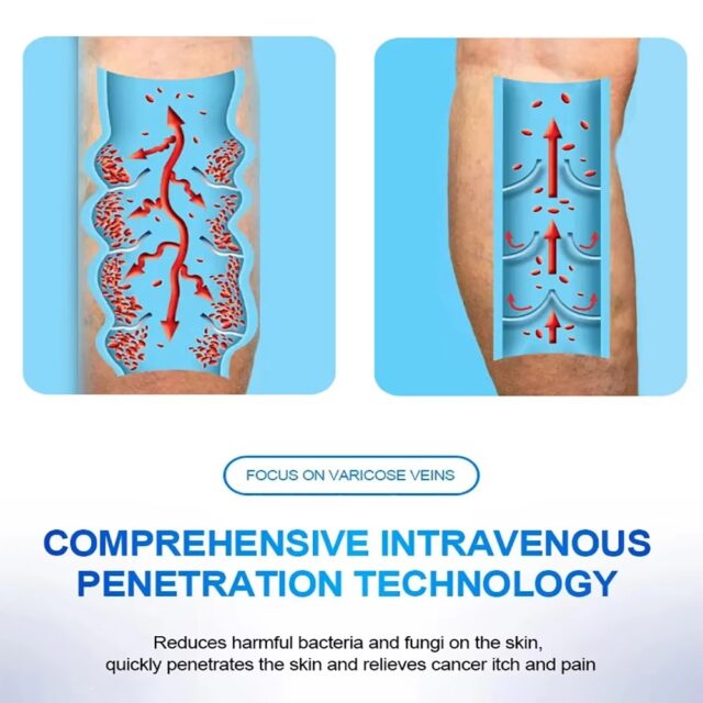 Varicose Veins Pen Relieves Pain & Improves Circulation - Image 5