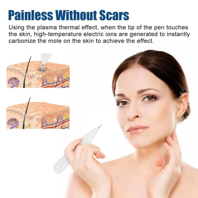 3-Level Plasma Pen for Freckle, Tattoo and Skin Tag Removal - Image 2
