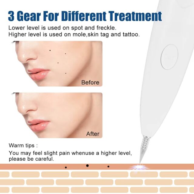 3-Level Plasma Pen for Freckle, Tattoo and Skin Tag Removal - Image 3