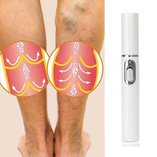 Varicose Veins Pen Relieves Pain & Improves Circulation - Image 7