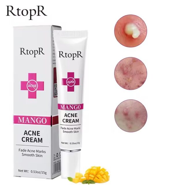 Acne Treatment Cream for Blackheads, Scars, and Oil Control - Image 8