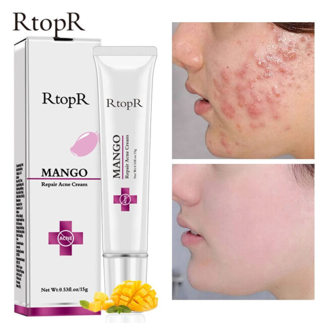 Acne Treatment Cream for Blackheads, Scars, and Oil Control - Image 2