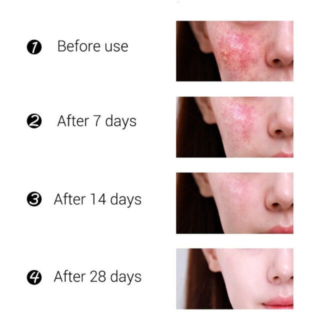 Acne Treatment Cream for Blackheads, Scars, and Oil Control - Image 5