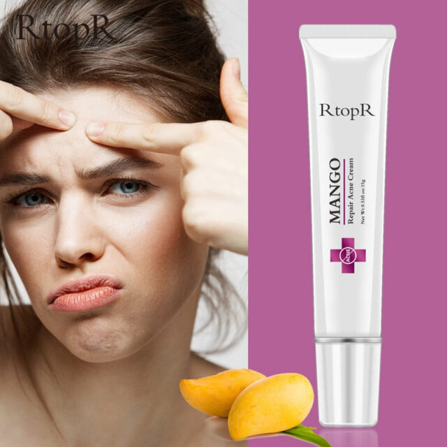 Acne Treatment Cream for Blackheads, Scars, and Oil Control