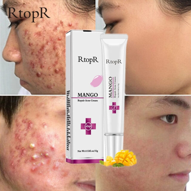 Acne Treatment Cream for Blackheads, Scars, and Oil Control - Image 6