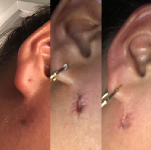 Herbal Scar Removal Gel Cream with Niacinamide and Growth Factor (30ml) photo review