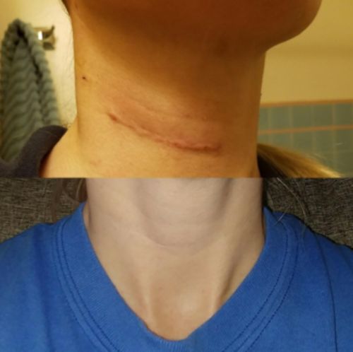 Herbal Scar Removal Gel Cream with Niacinamide and Growth Factor (30ml) photo review
