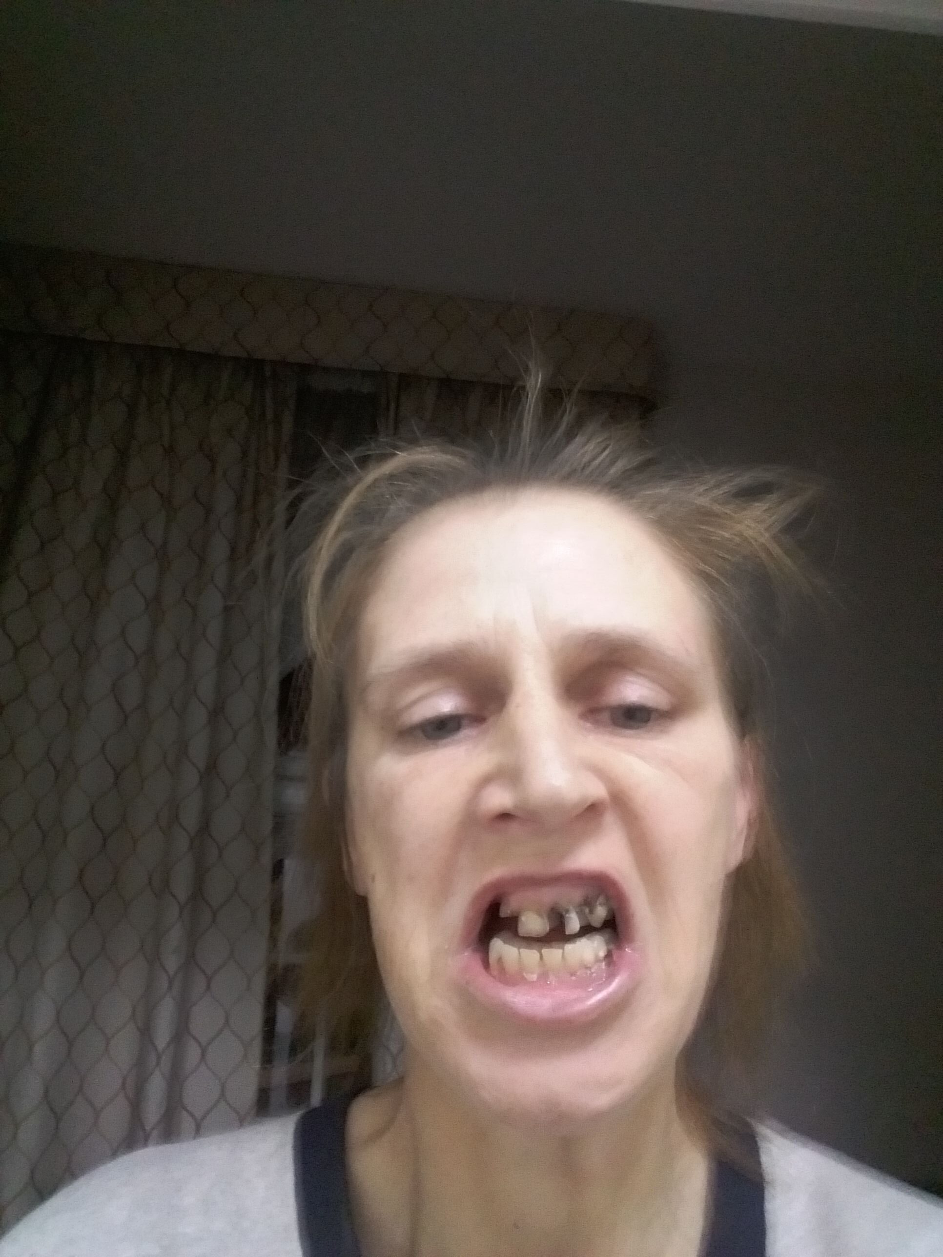 Reusable Silicone Dentures For Upper And Lower Jaws photo review