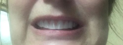 Reusable Silicone Dentures For Upper And Lower Jaws photo review