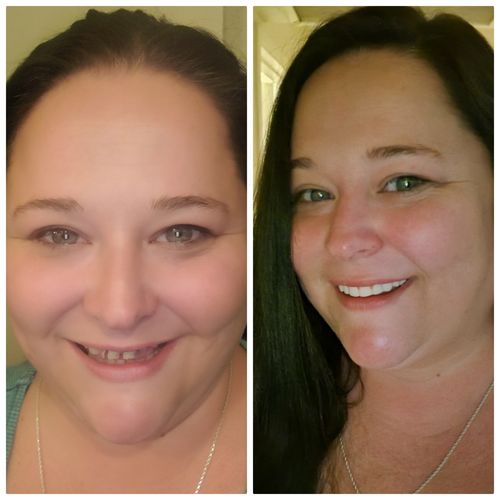Reusable Silicone Dentures For Upper And Lower Jaws photo review