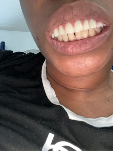 Reusable Silicone Dentures For Upper And Lower Jaws photo review