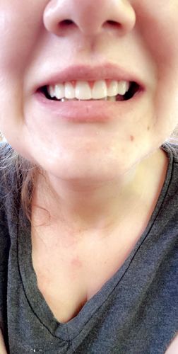 Reusable Silicone Dentures For Upper And Lower Jaws photo review