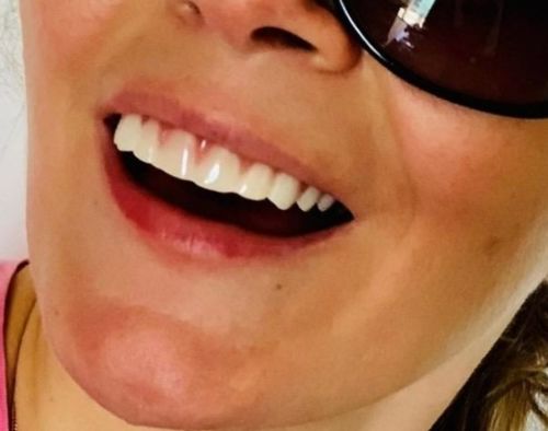 Reusable Silicone Dentures For Upper And Lower Jaws photo review