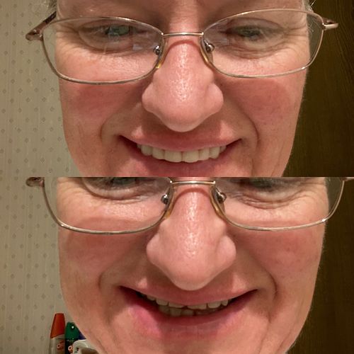 Reusable Silicone Dentures For Upper And Lower Jaws photo review