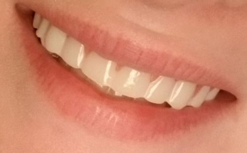 Reusable Silicone Dentures For Upper And Lower Jaws photo review