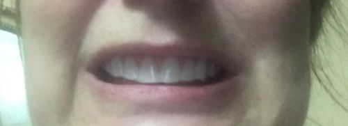 Reusable Silicone Dentures For Upper And Lower Jaws photo review