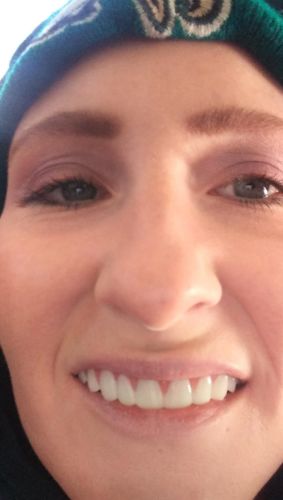 Reusable Silicone Dentures For Upper And Lower Jaws photo review