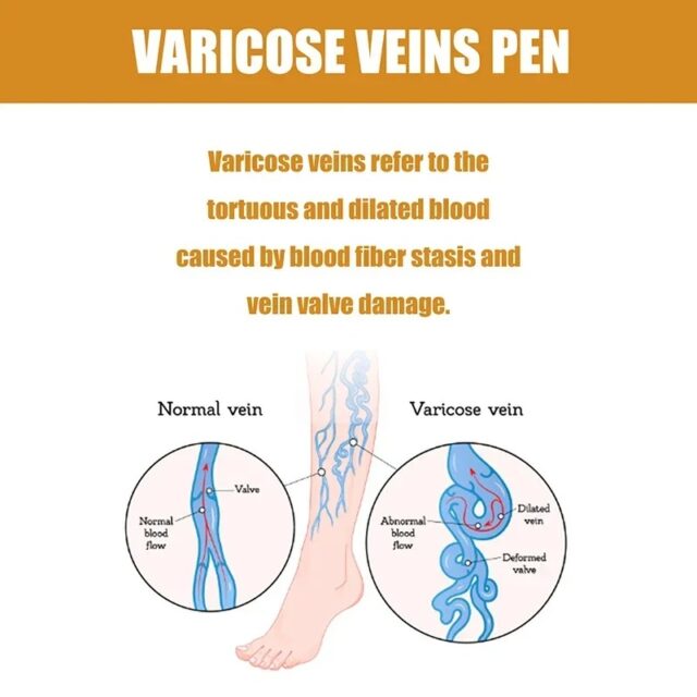 Varicose Veins Pen Relieves Pain & Improves Circulation - Image 4