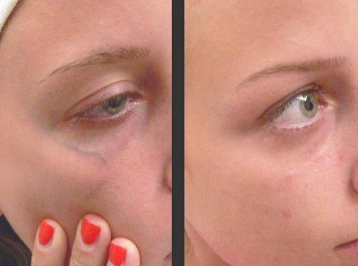 Blue Light Therapy Acne Pen with Scar Repair Cream (15g) photo review