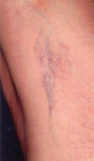 Blue Light Therapy Acne Pen with Scar Repair Cream (15g) photo review
