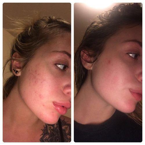Blue Light Therapy Acne Pen with Scar Repair Cream (15g) photo review
