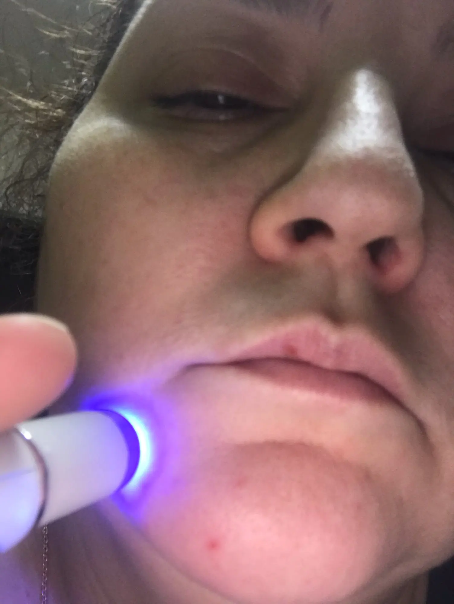 Varicose Veins Pen Relieves Pain & Improves Circulation photo review