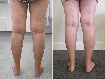 Varicose Veins Pen Relieves Pain & Improves Circulation photo review
