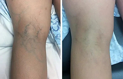 Varicose Veins Pen Relieves Pain & Improves Circulation photo review