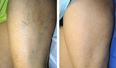 Varicose Veins Pen Relieves Pain & Improves Circulation photo review